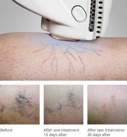 exotherme-laser-before-after-spider-veins